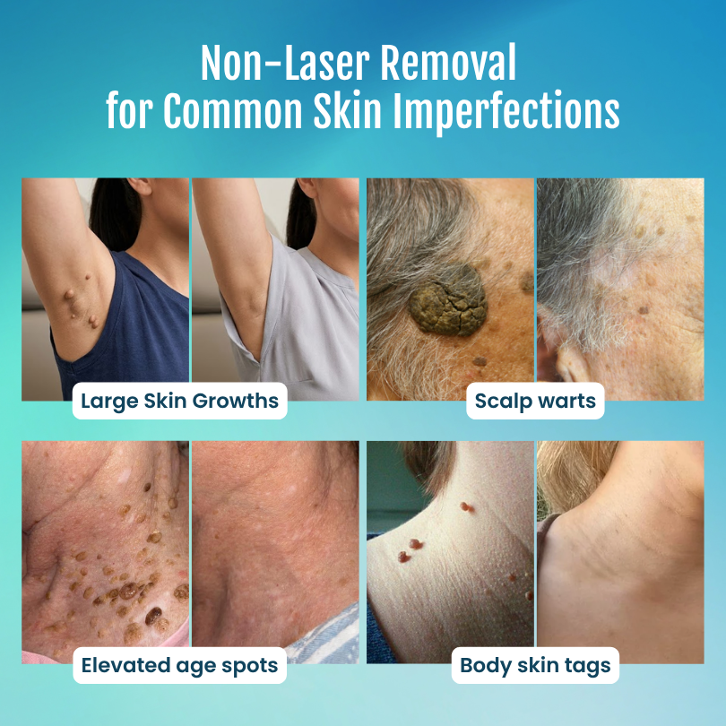 SpotlessPro® 7-Day Advanced Blemish & Tag Eraser