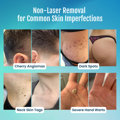 SpotlessPro® 7-Day Advanced Blemish & Tag Eraser