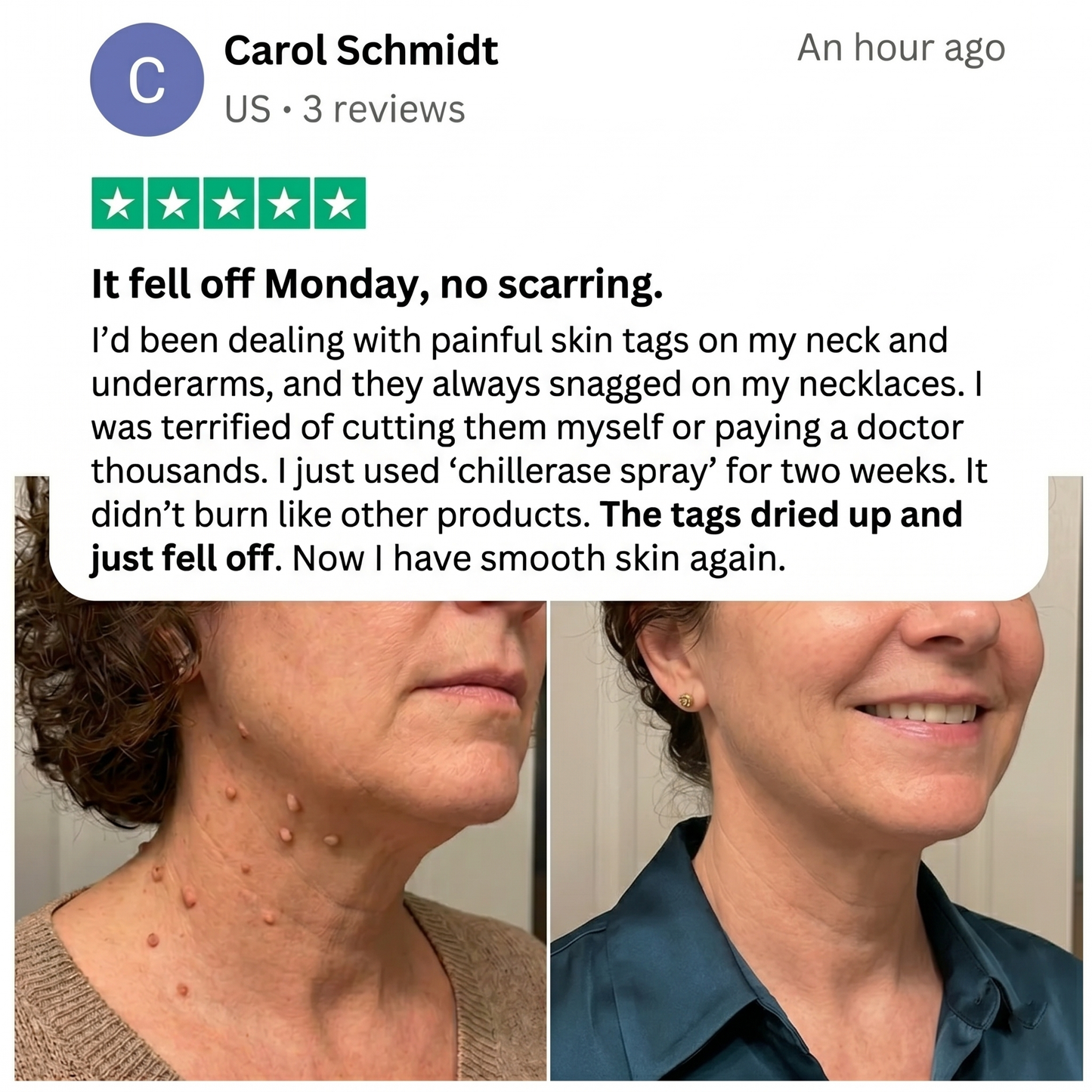 ChillErase® Precision Skin Tag & Wart Removal Spray