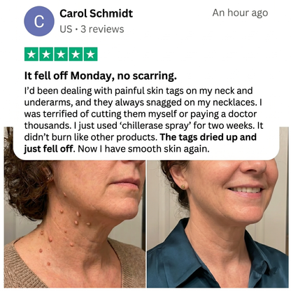 ChillErase® Precision Skin Tag & Wart Removal Spray