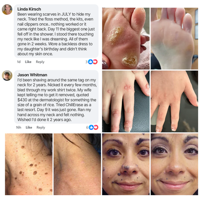 ChillErase® Precision Skin Tag & Wart Removal Spray